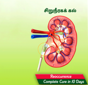 Diawin-Siddha-Hospital-Kidney-Stone-Treatments