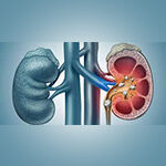 Kidney stone - Diawin Siddha Treatment