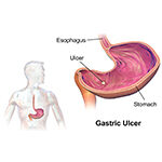 Diawin siddha Gastric ulcer